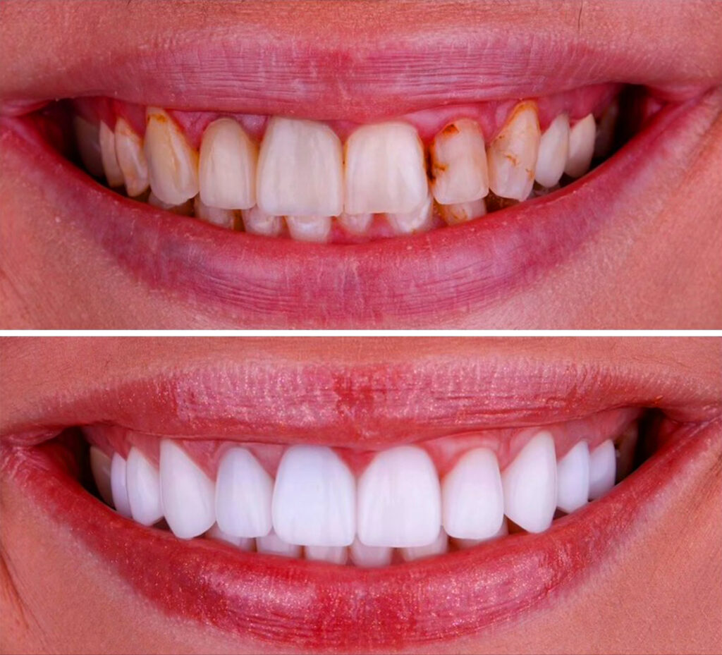 composite bonding London